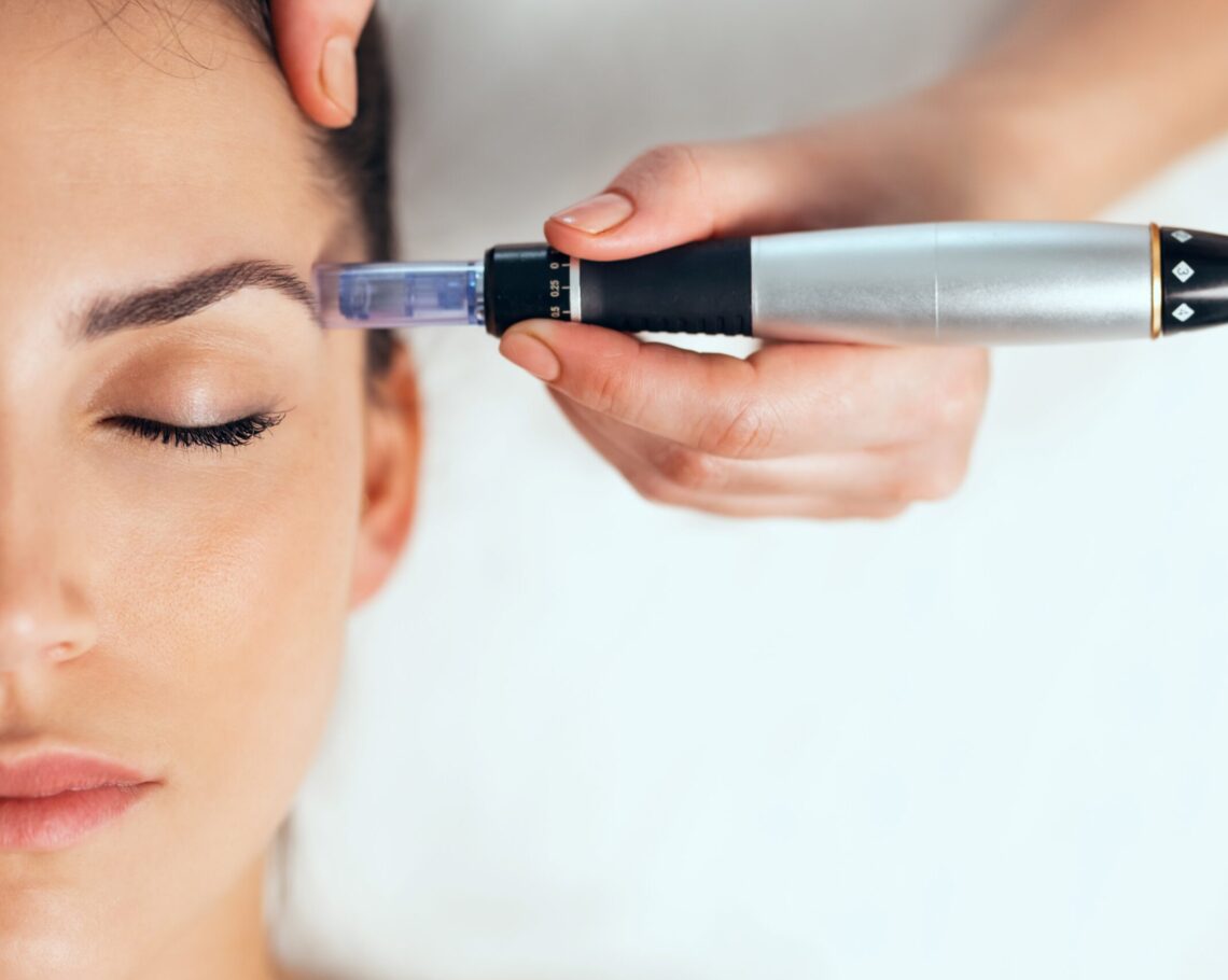 Rf microneedling